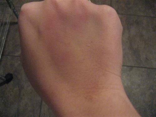 My Bruised Hand After Almost A Week Just Because I m Bored 