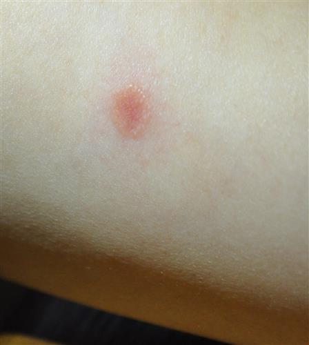 Has anyone here ever gotten ringworm? Photo of the bite/rash