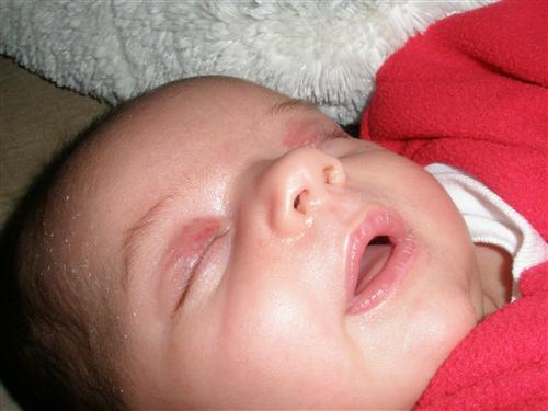 Red Eyelids And Newborns 